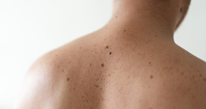 The ABCDE Rule for Identifying Dangerous Moles