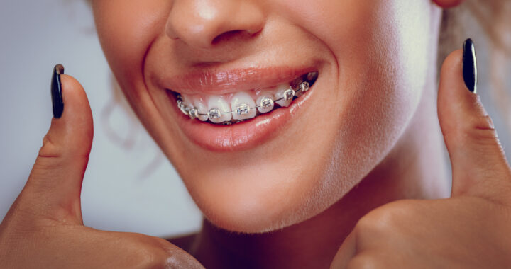 Orthodontic Options for Teens: Beyond Traditional Braces